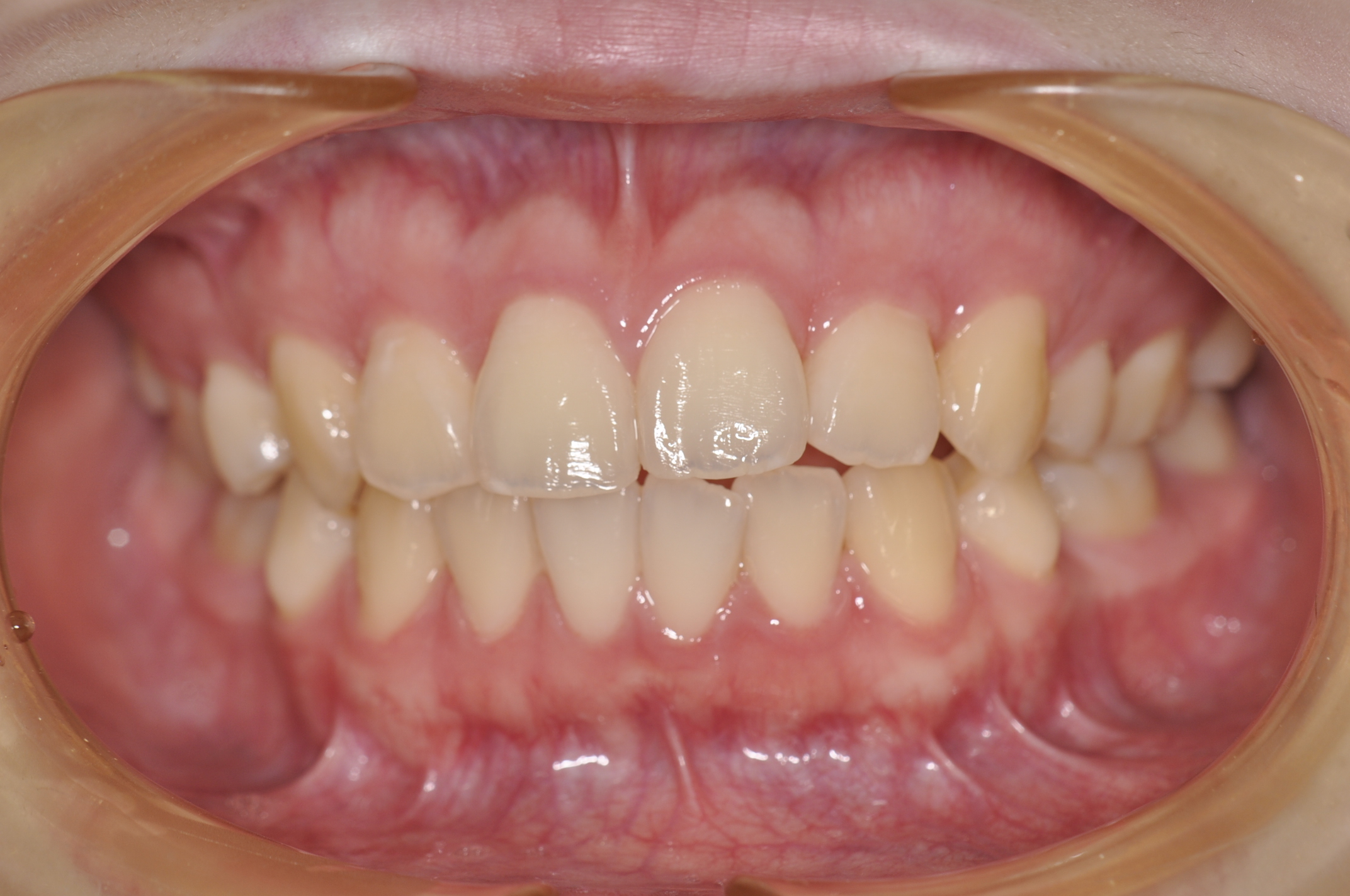 盛岡 矯正 インビザライン