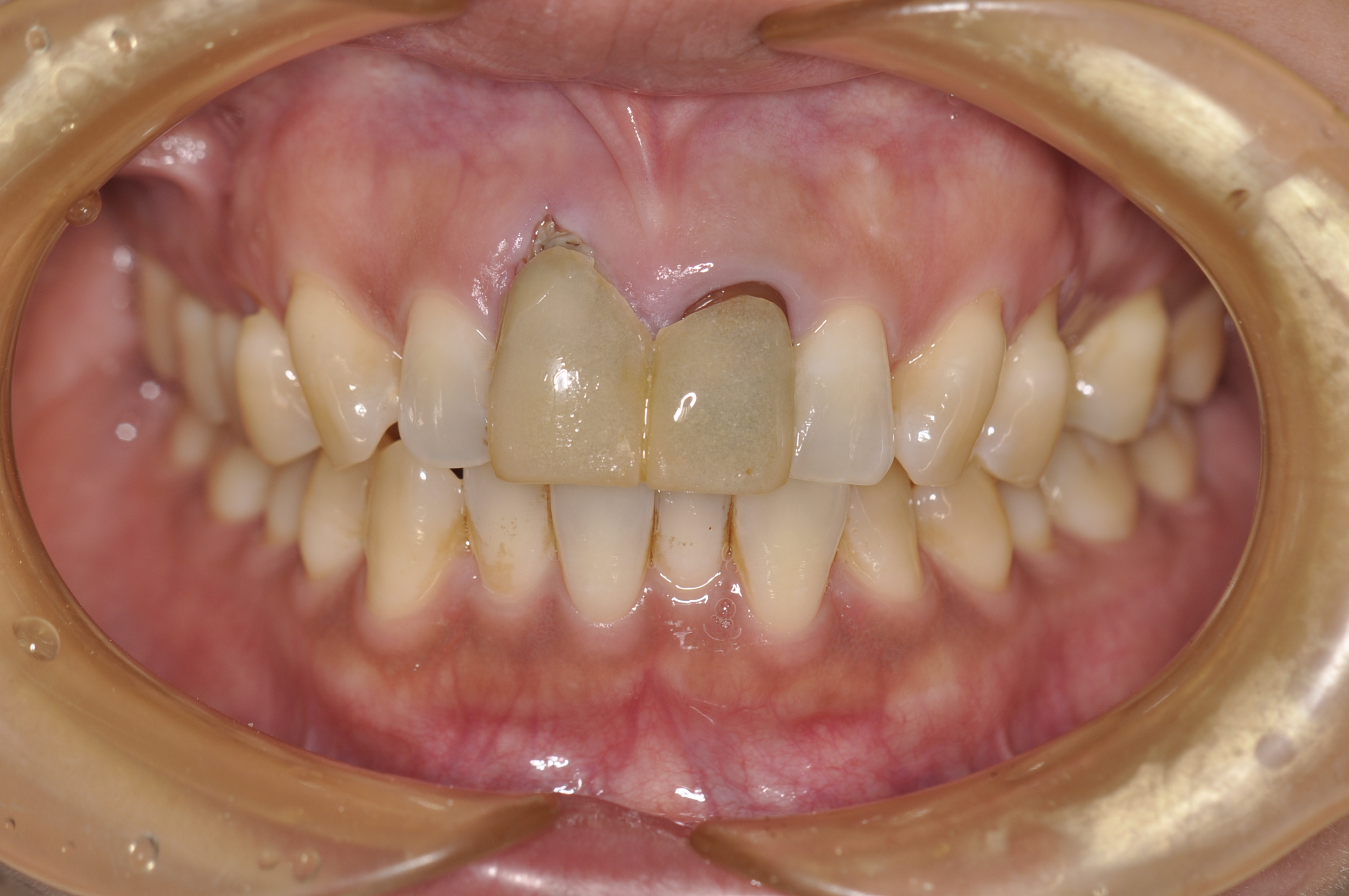 盛岡 審美 セラミック