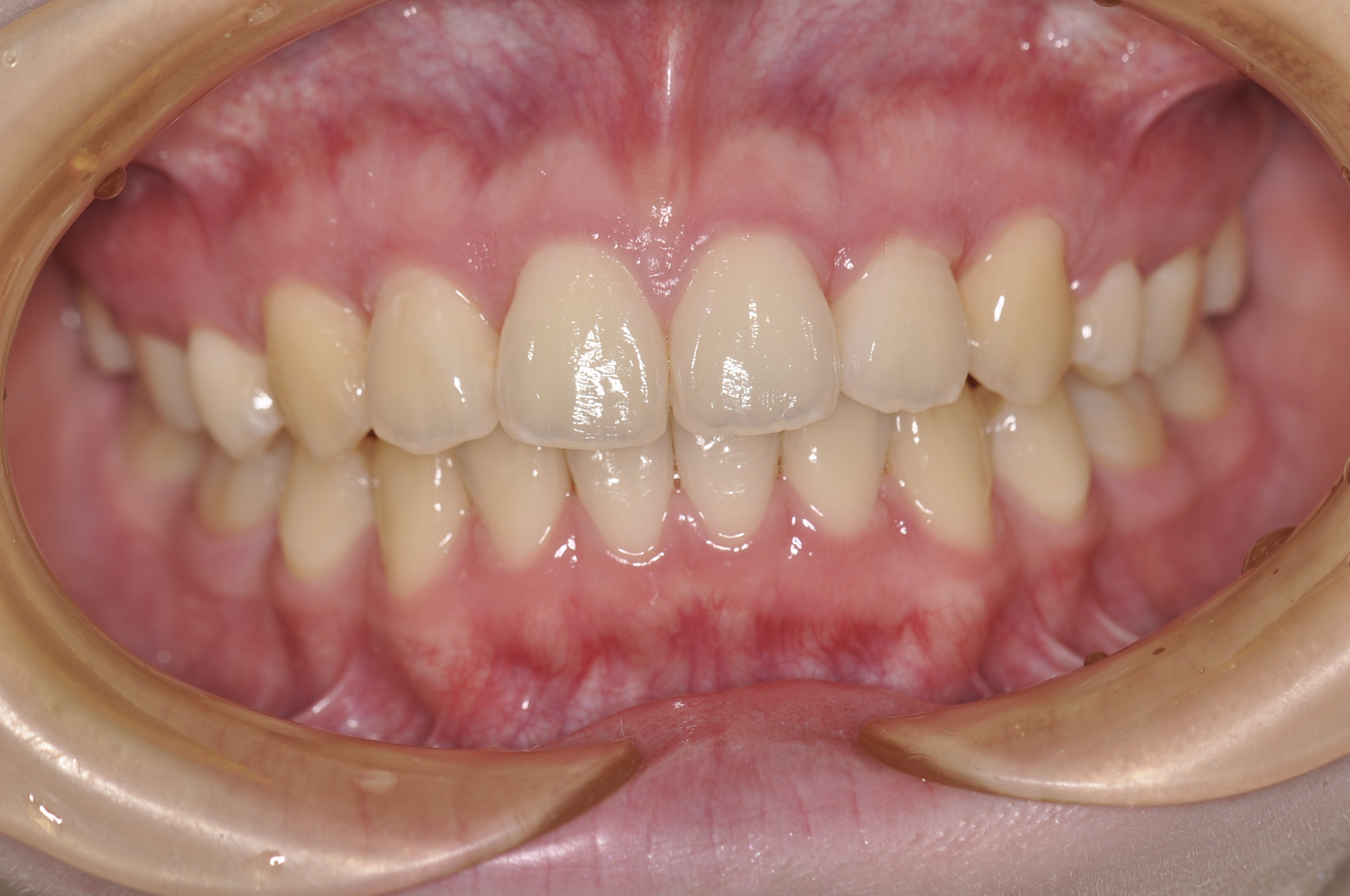 盛岡 矯正 インビザライン