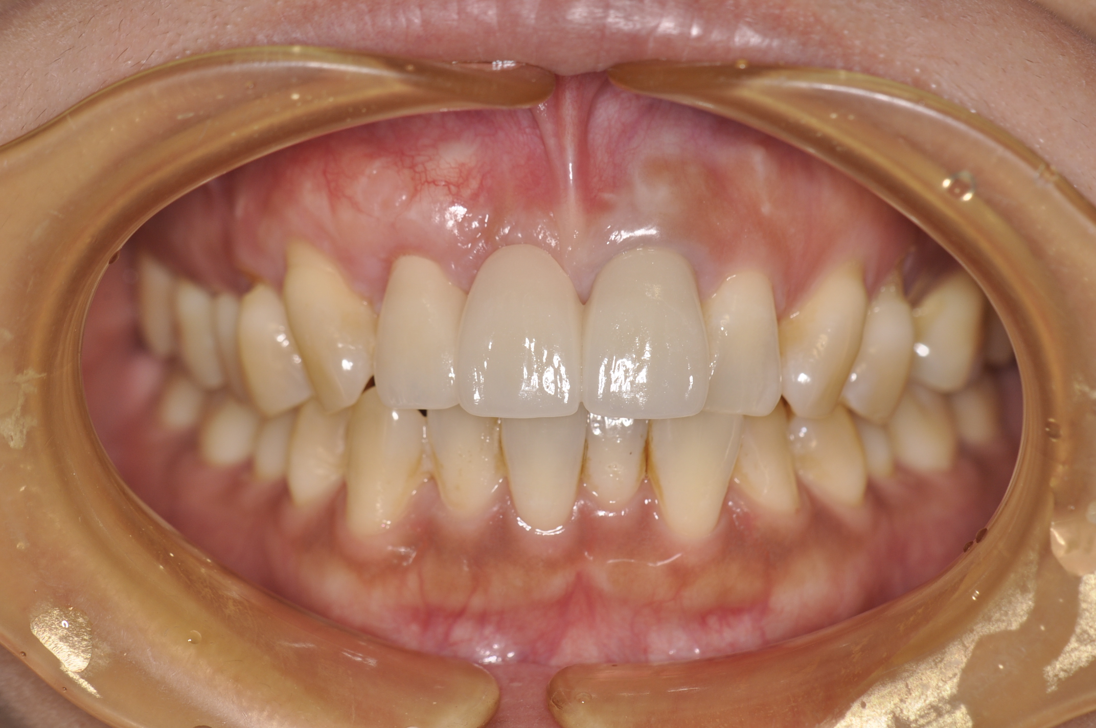 盛岡市 セラミック 審美