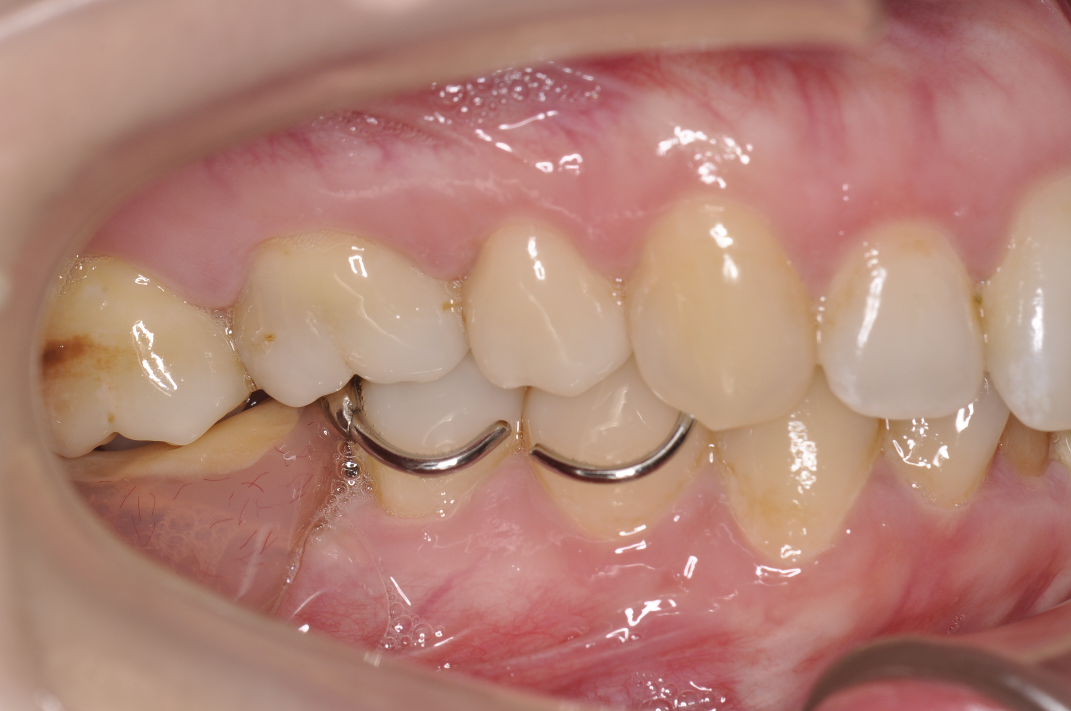 盛岡 インプラント