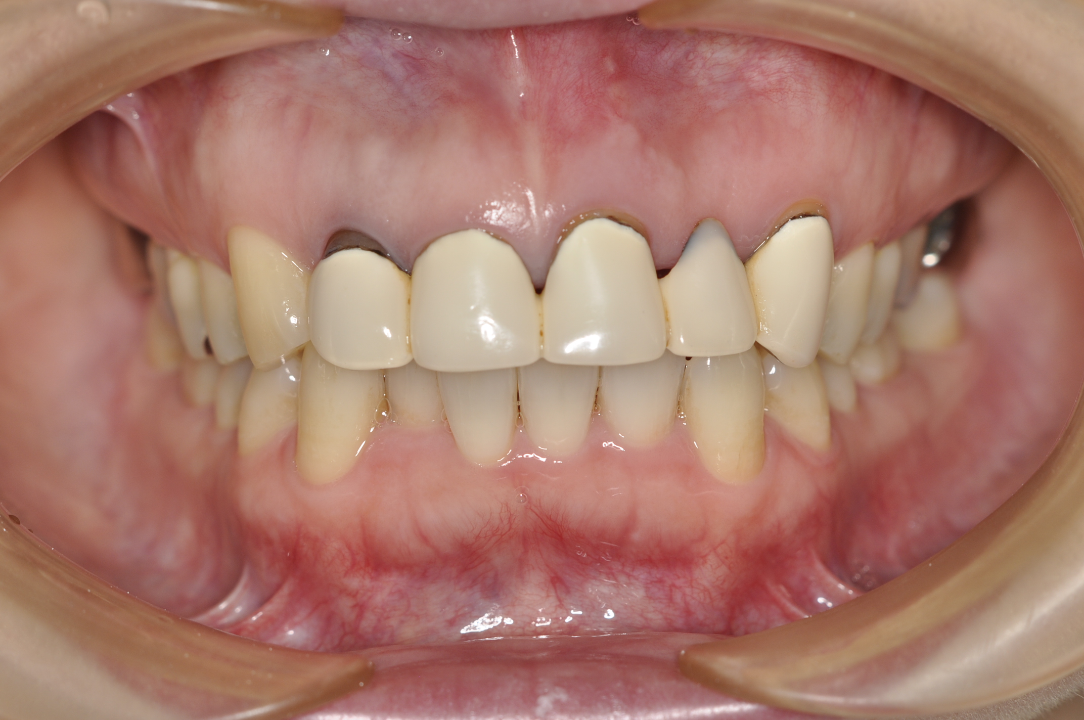 盛岡 矯正 審美