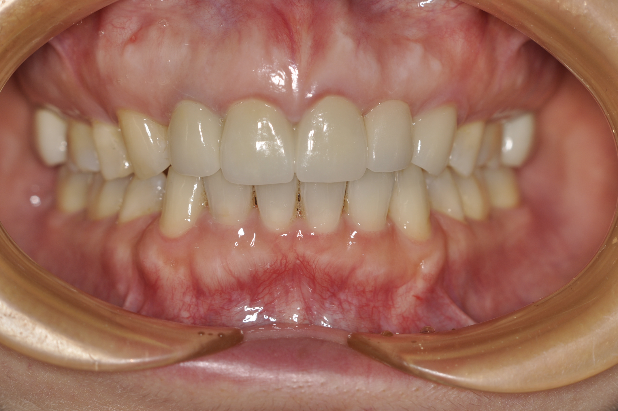 盛岡 矯正 審美