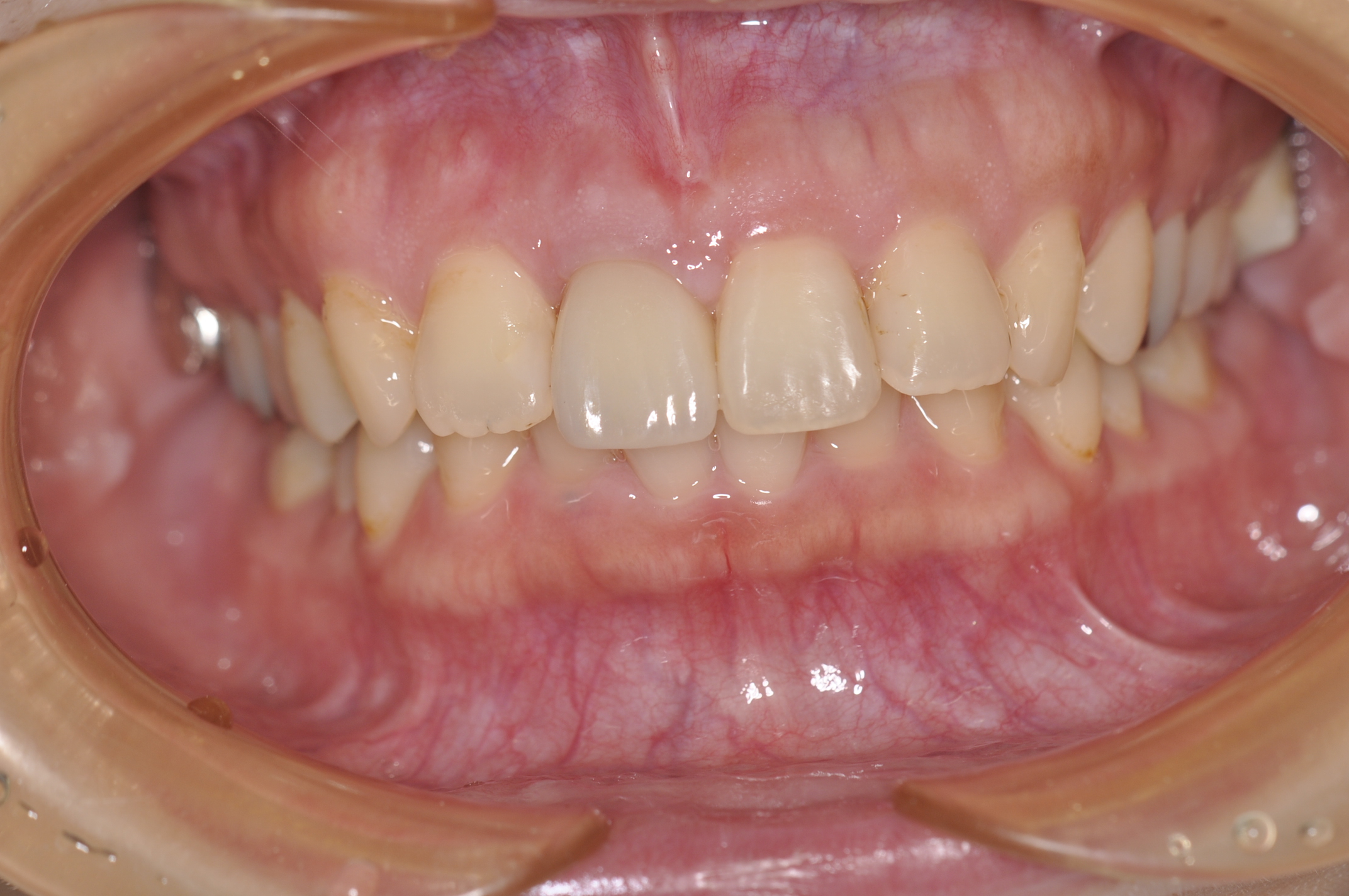 盛岡 審美歯科 矯正治療