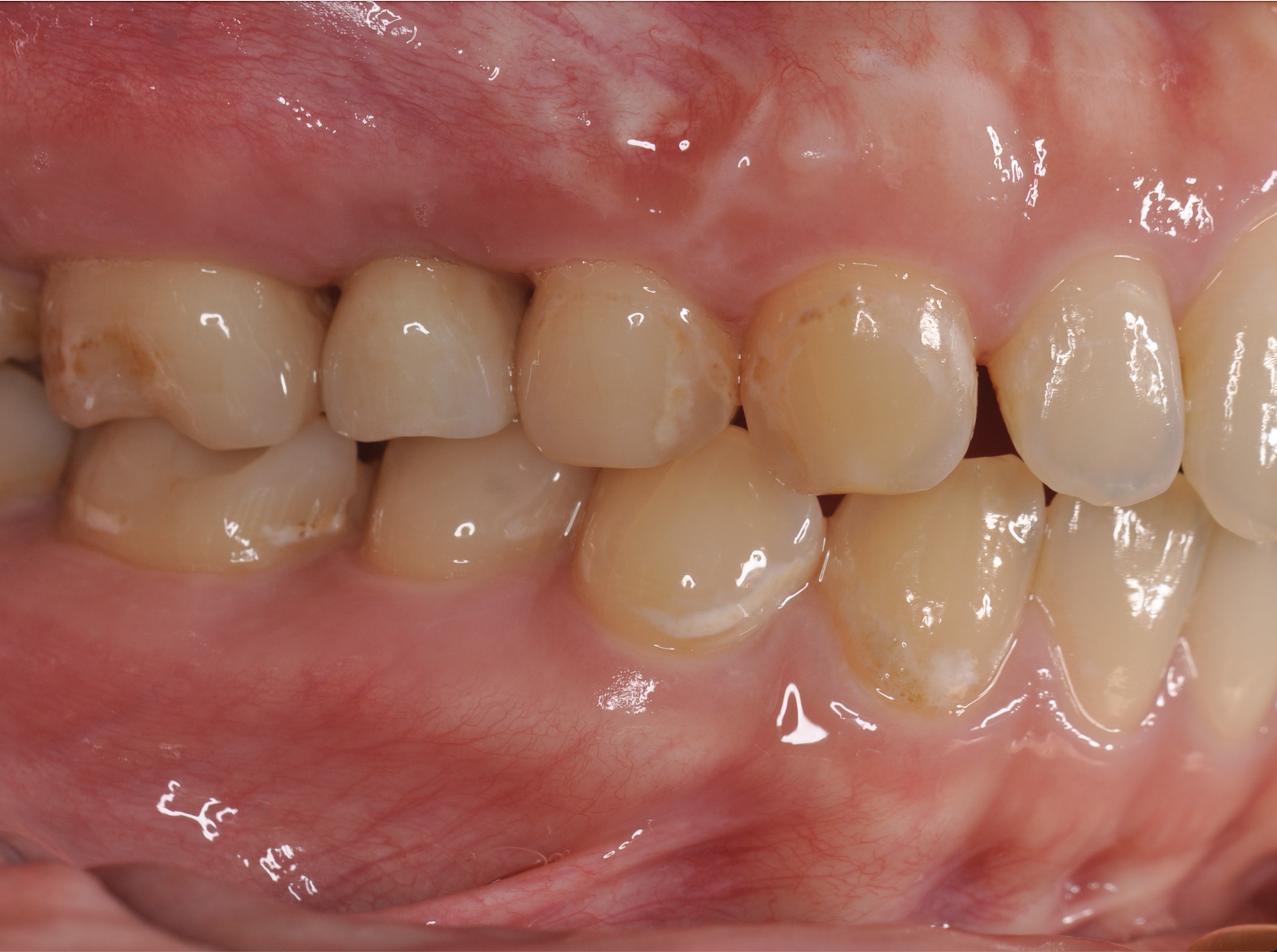 盛岡 歯科 インプラント