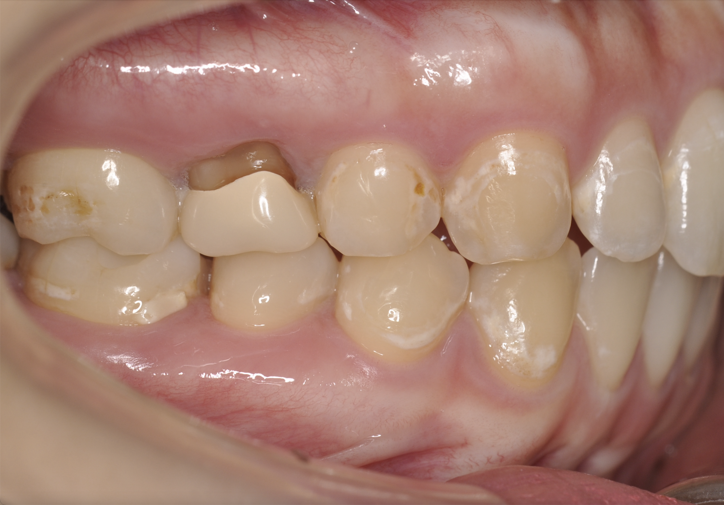盛岡 インプラント お勧め