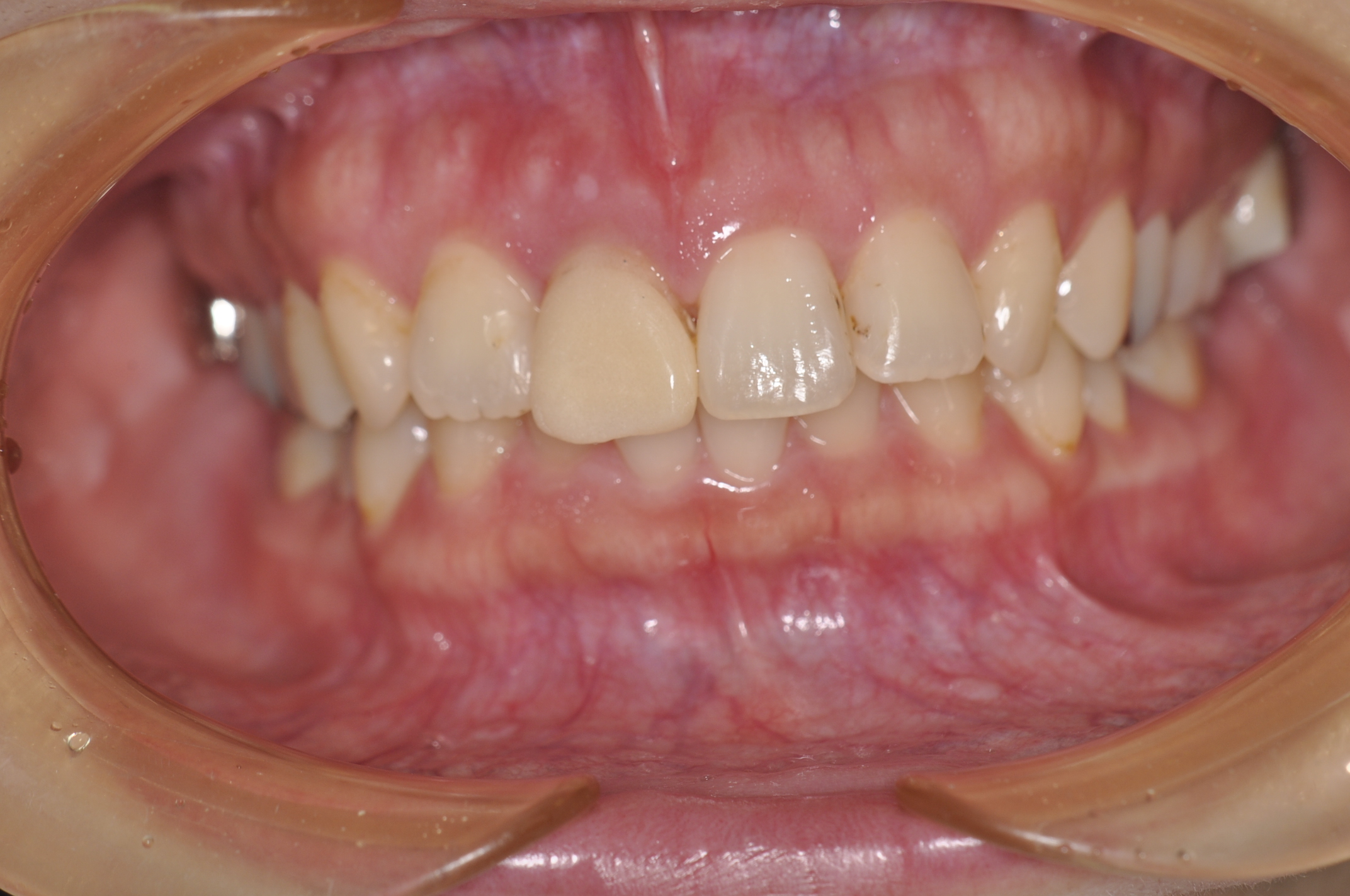 盛岡 審美歯科 矯正治療