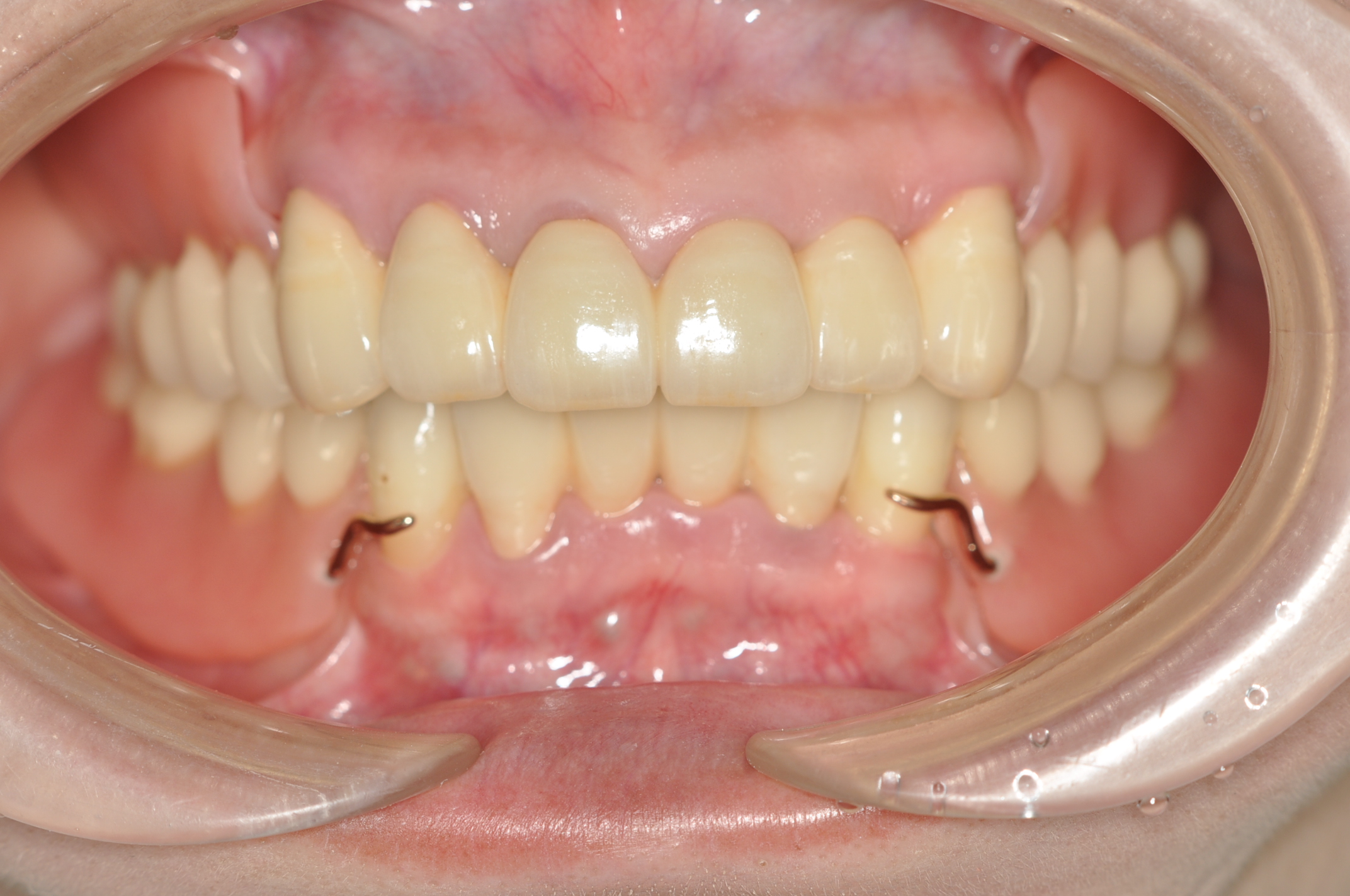 歯周病 義歯 盛岡 安藤歯科