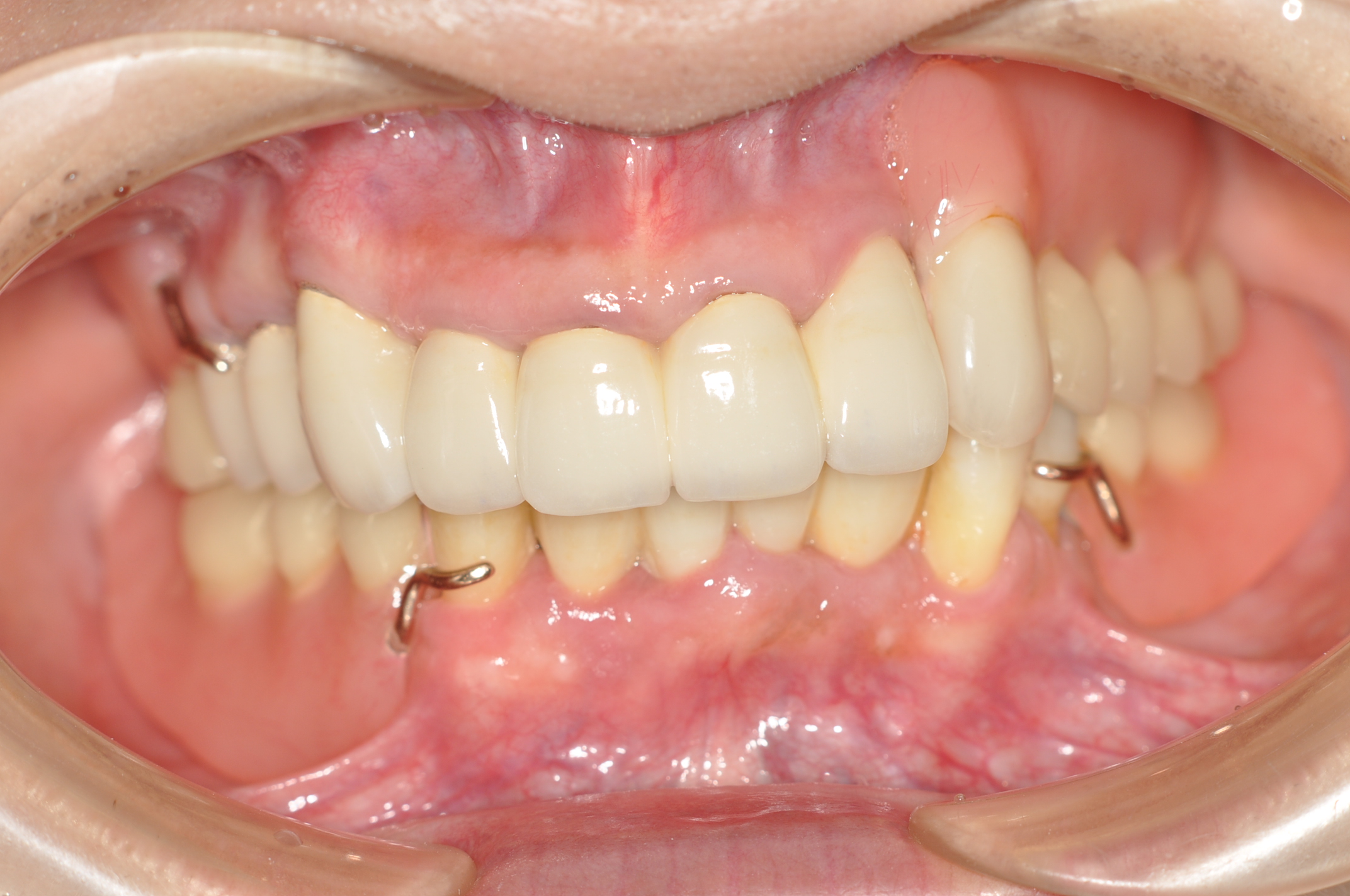 盛岡 義歯 審美 歯周病