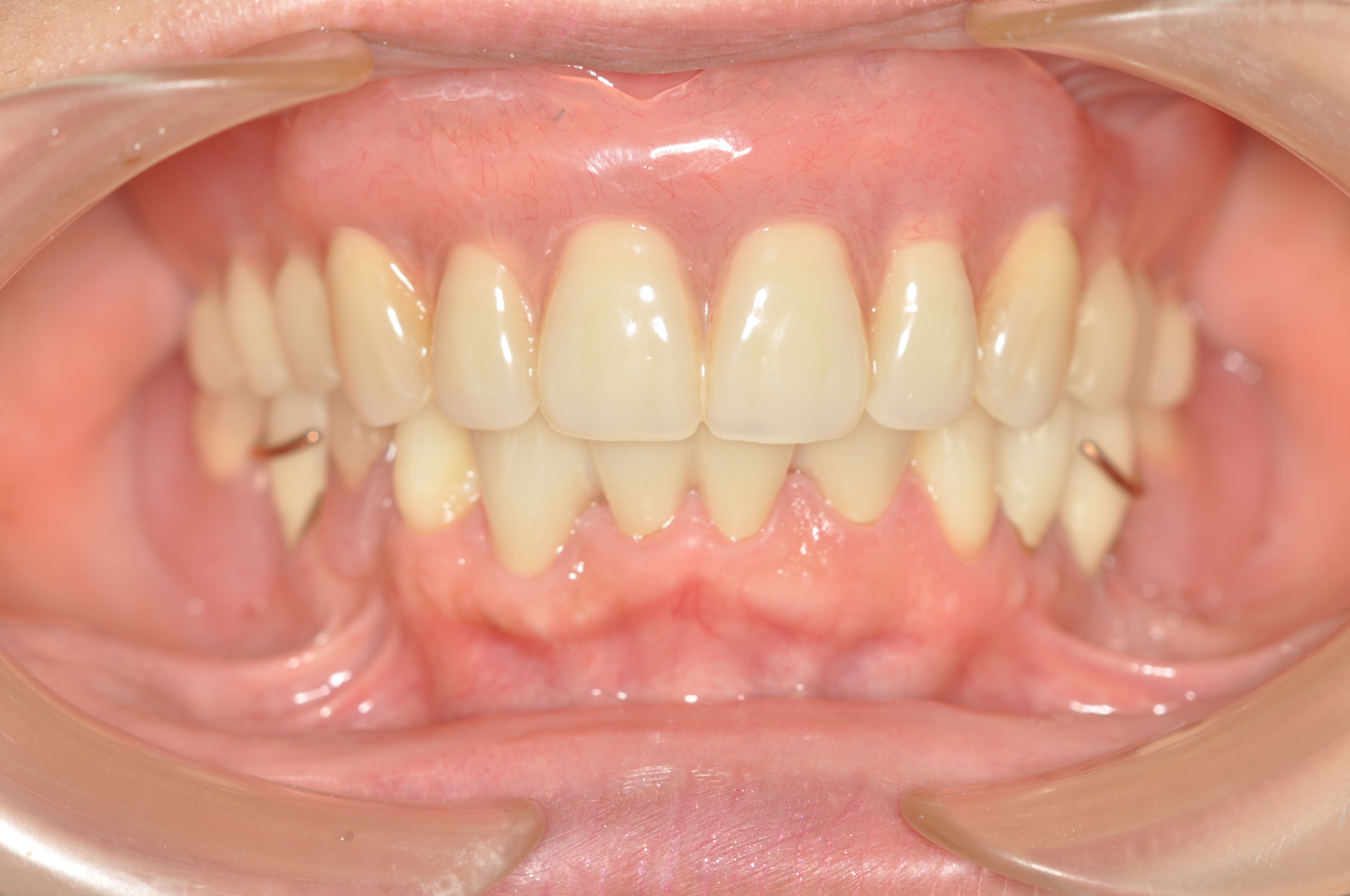 盛岡 義歯 安藤歯科