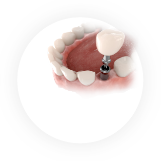 インプラント治療